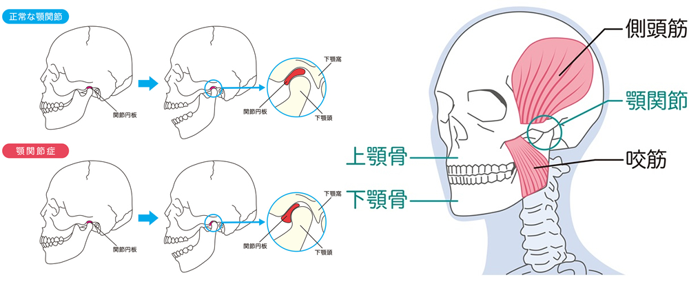 顎関節症とは?解説画像