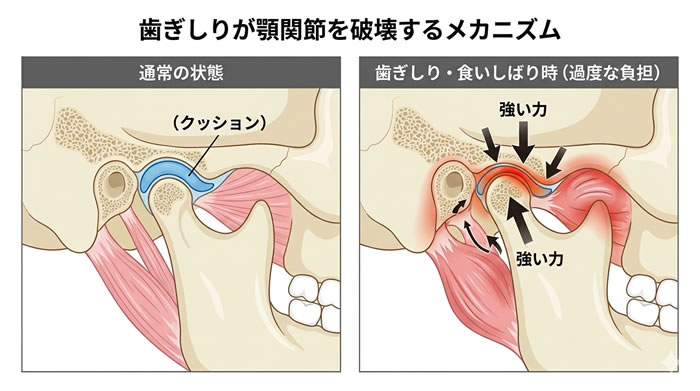 歯ぎしりが顎関節を破壊するメカニズム